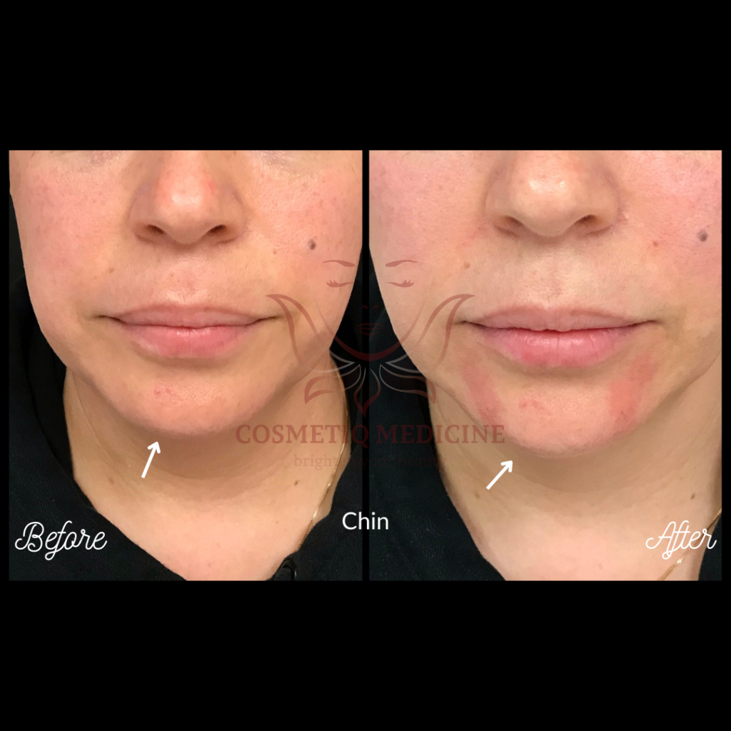 Juvederm Chin Filler Before and After