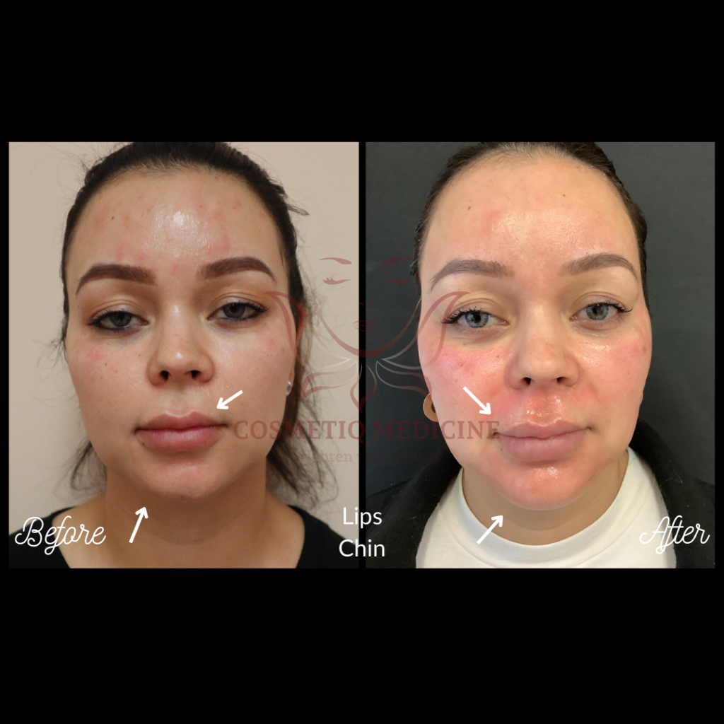 Juvederm Lip Chin Filler Before and After