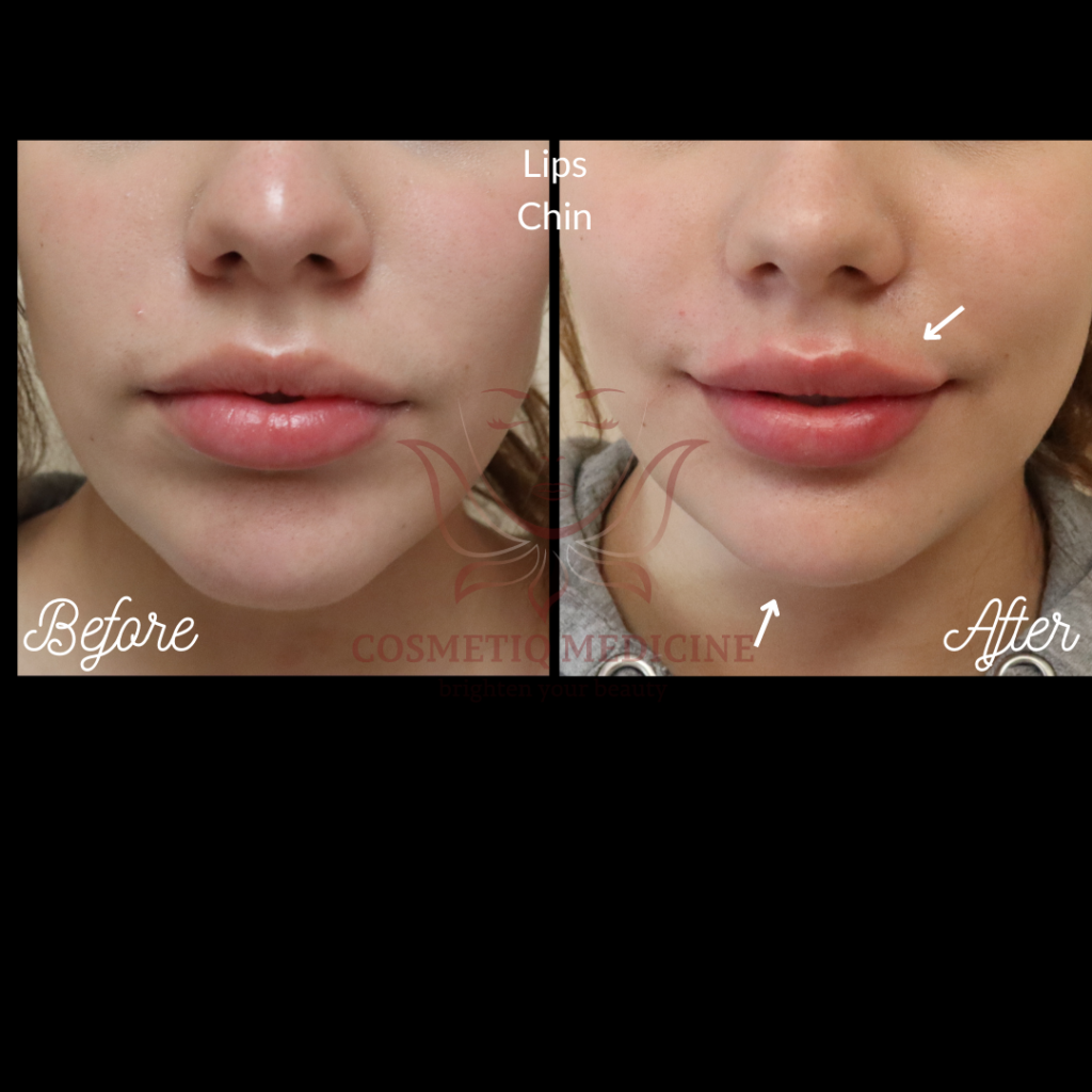 Juvederm Lip Chin Filler Before and After