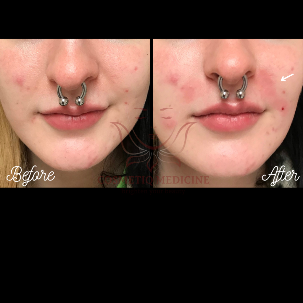 Juvederm NLF Filler Before and After