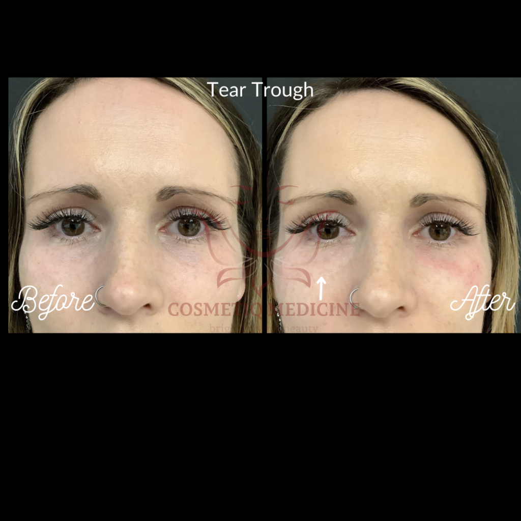 Juvederm Tear Trough Under Eye Filler Before and After