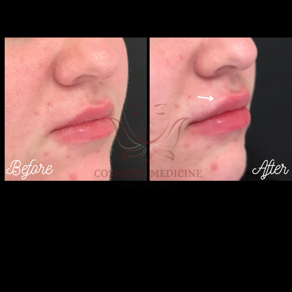 Juvederm Lip Filler Before and After