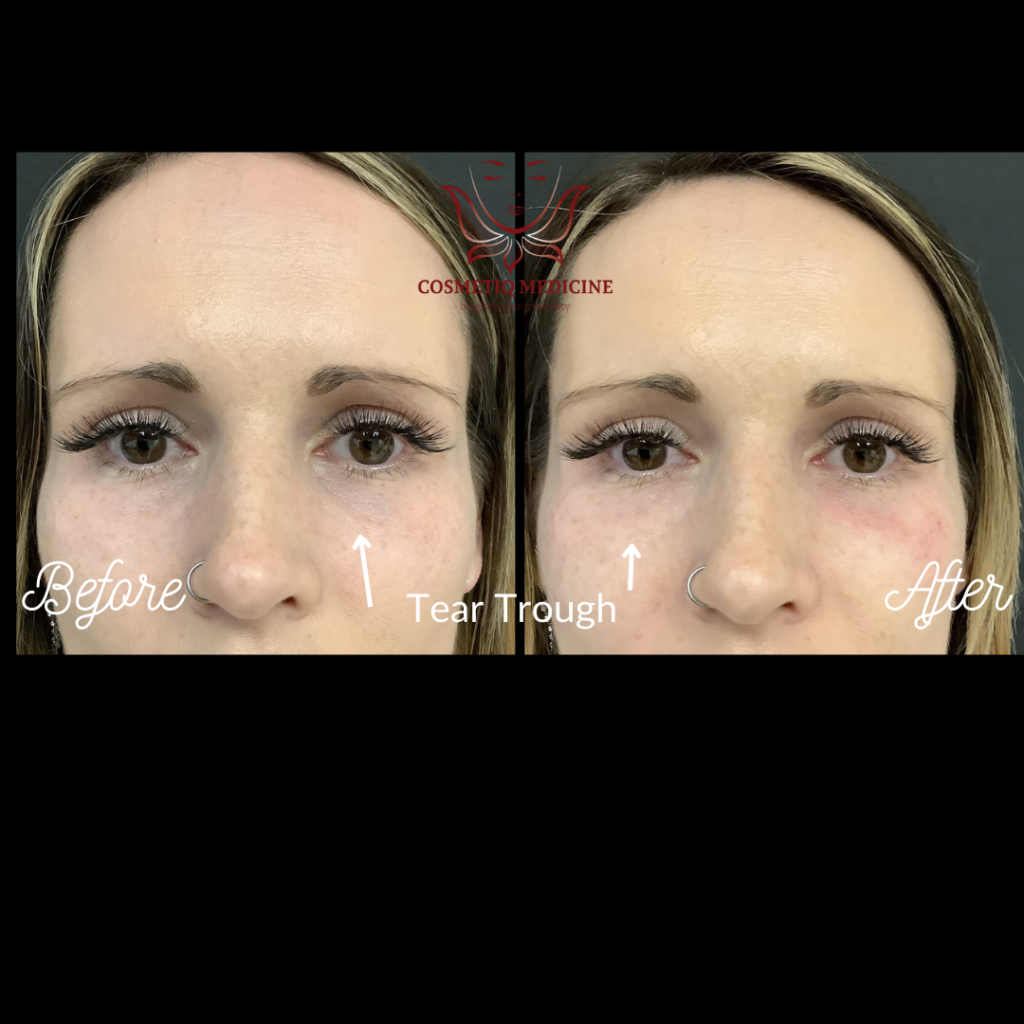 Juvederm Tear-Trough Filler Before and After