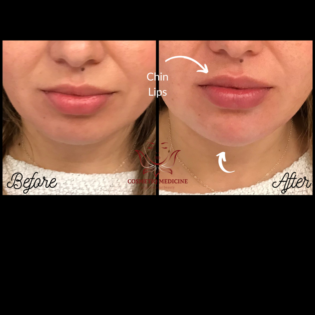 Juvederm Chin and Lip Filler Before and After