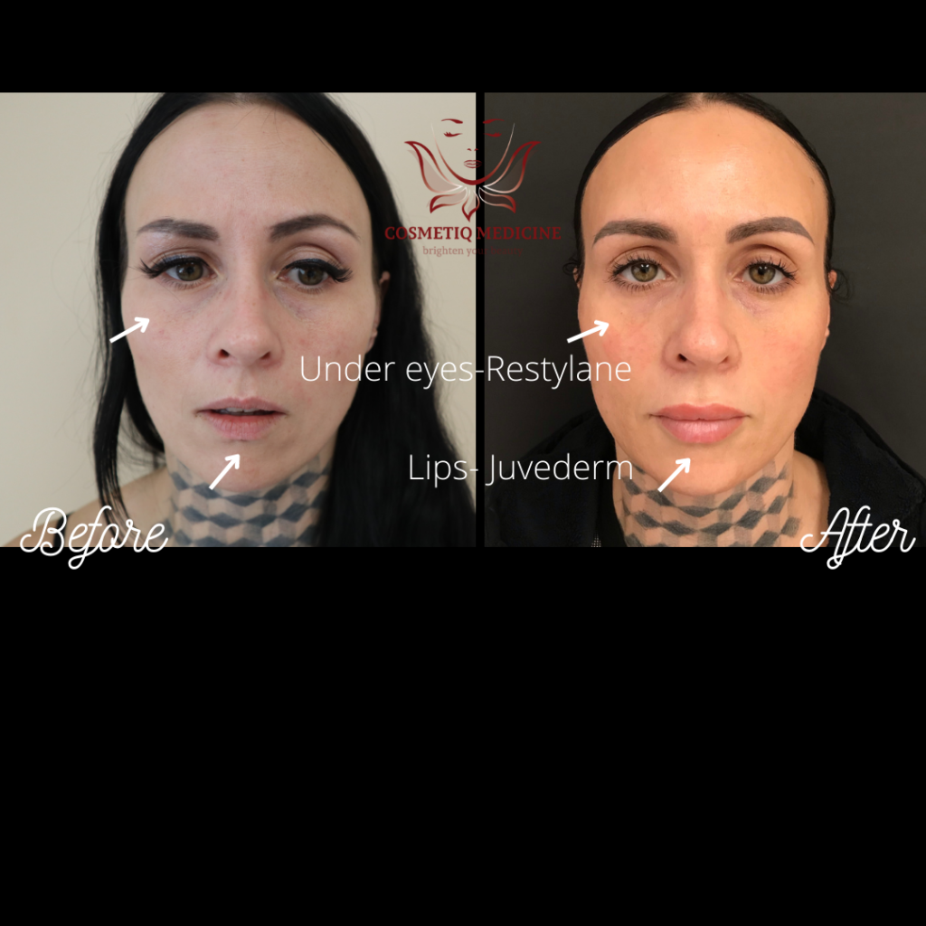 Restalyne Under Eye Filler Juvederm Lip Filler Before and After
