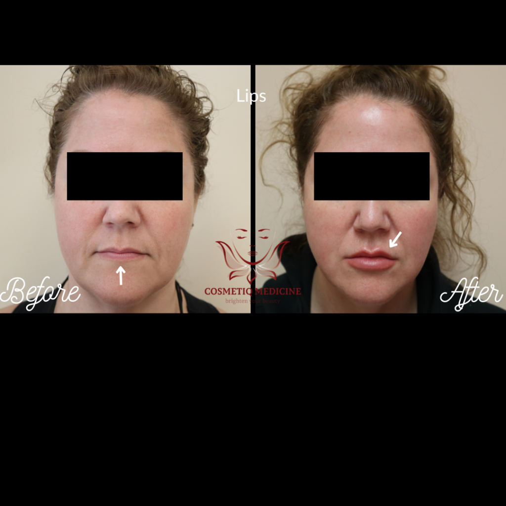 Juvederm Lip Filler Before and After