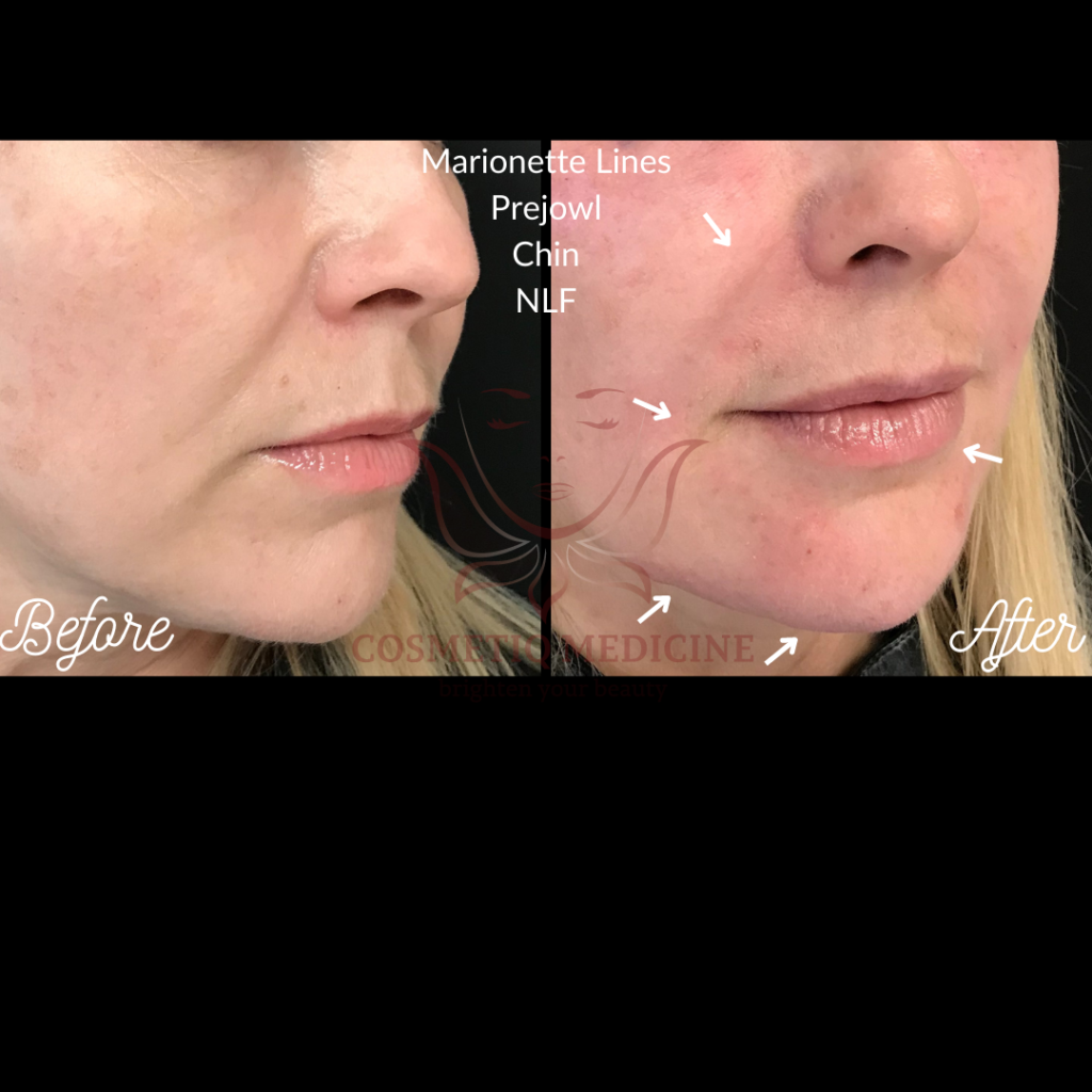 Juvederm Marionette Lines Prejowl Chin NLF Filler Before and After