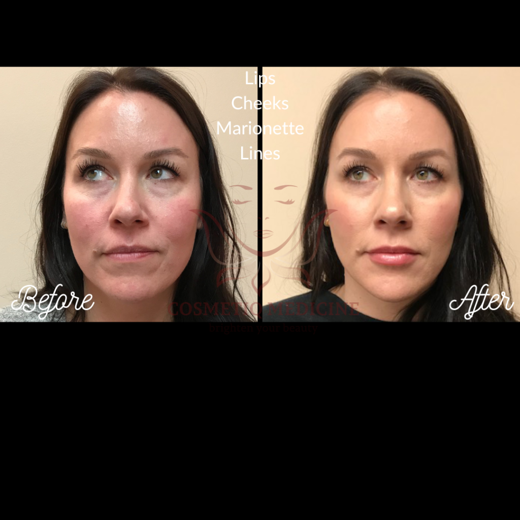 Juvederm Filler Lip Cheek Marionette Lines Before and After