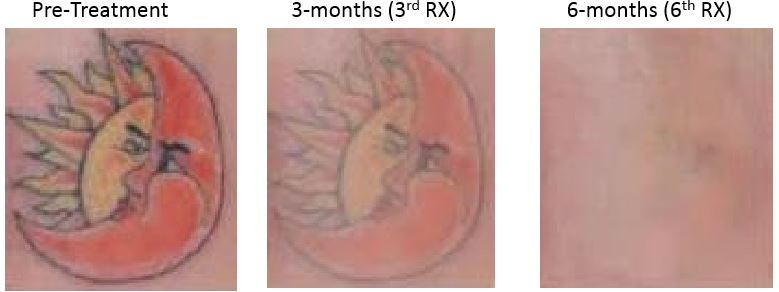 Image showing Tattoo Removal in three stages. The first is the tattoo pre-treatment. After is tattoo in the process of fading over three months and three treatments. The last is the almost entirely clear skin after six months and six treatments.