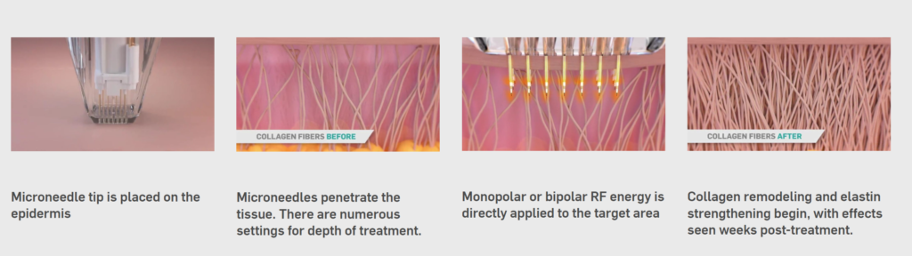 Photo showing the how Potenza functions, with the microneedling tip being placed on the epidermis and penetrating the skin tissue to remodel the collagen beneath using Radio Frequency energy.