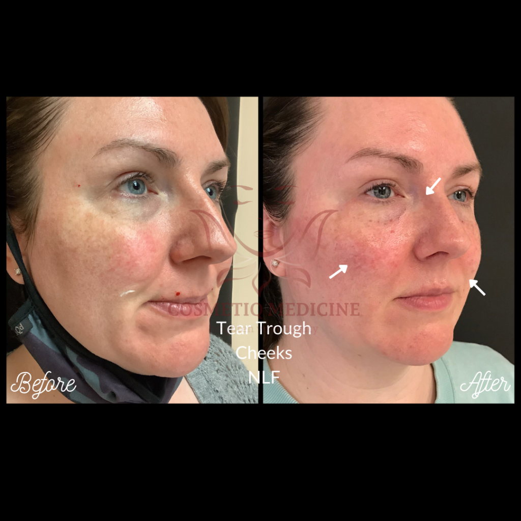 Juvederm Tear Trough Under Eye Cheeks NLF Filler Before and After