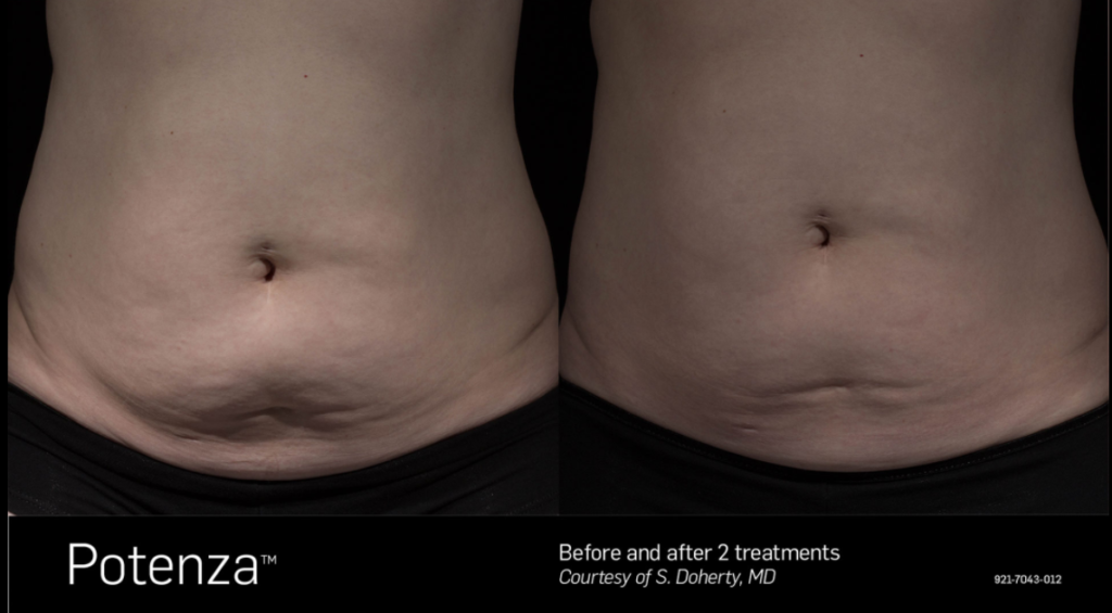 Before and After photo, showing tightening of skin around stomach for patient.