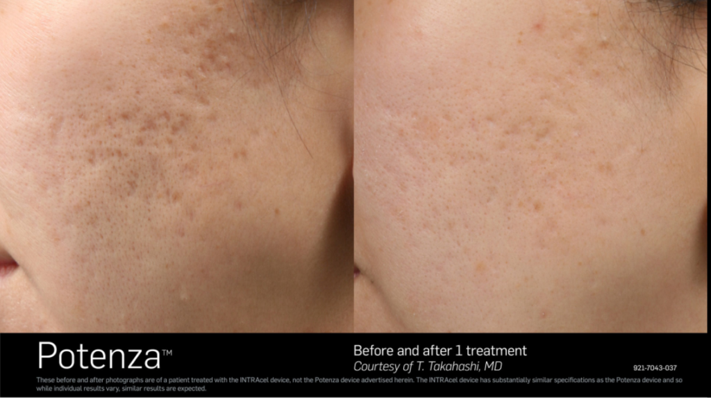 Before and After photo, showing removal of dark spots on patient's cheek.