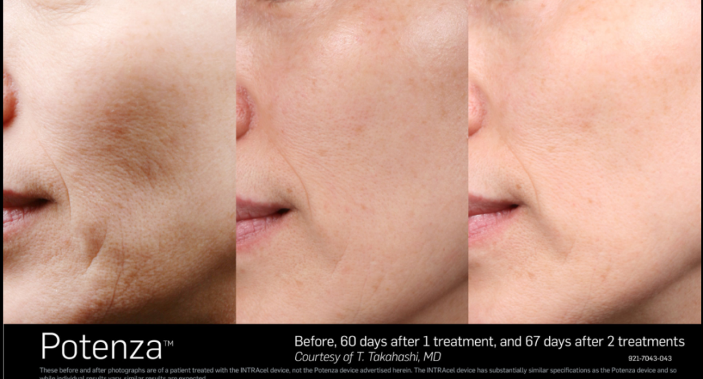Three stage Before and After photo, showing tightening of facial skin and removal of wrinkles for patient.