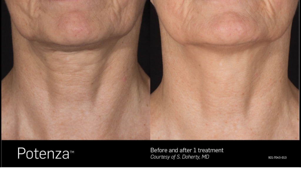 Before and After Photo for Potenza, showing tightening of patient's skin around the neck.