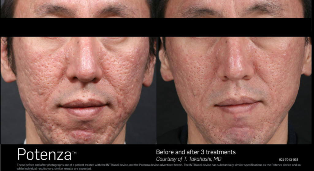 Before and After photo, showing reduction in pore size on patient's face.