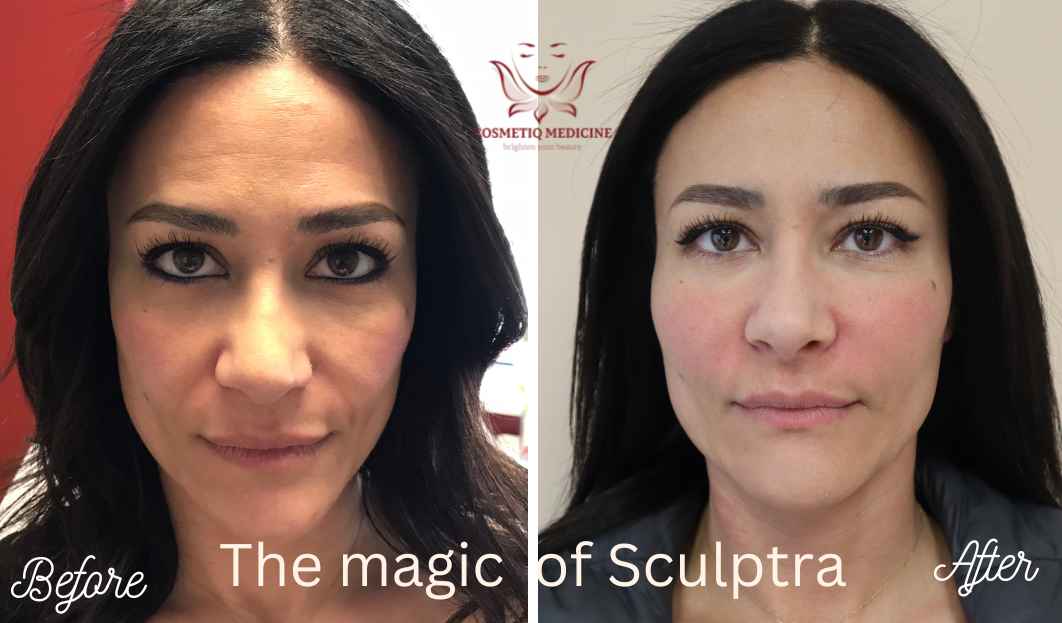 A woman’s face before and after Sculptra treatments.