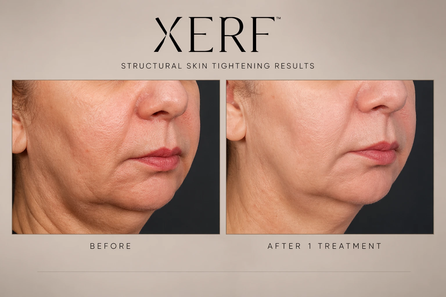 XERF skin tightening before and after result at Cosmetiq Medicine Vancouver WA