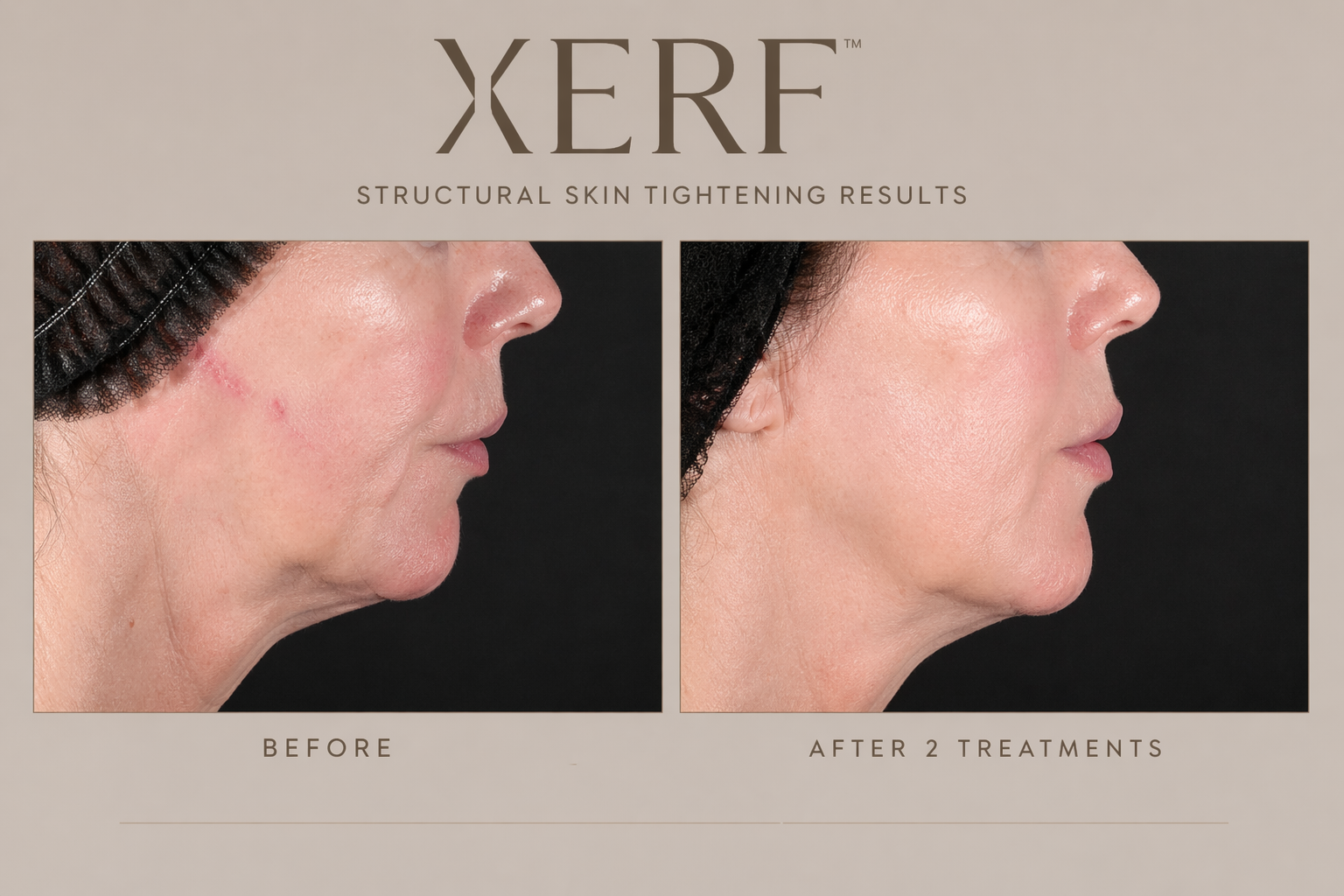 XERF non-surgical facial rejuvenation before and after at Cosmetiq Medicine serving Portland OR