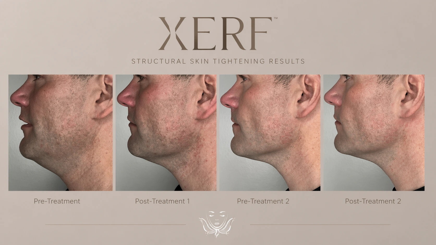 XERF skin tightening before and after results at Cosmetiq Medicine Vancouver WA serving Portland OR