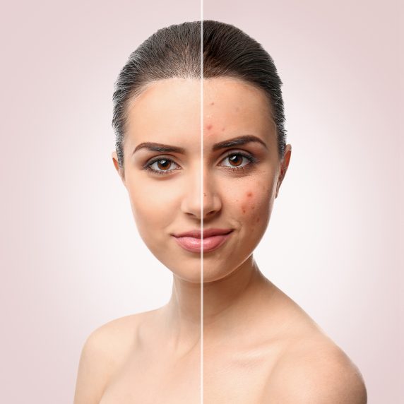 A woman’s face with one clear side and another with acne