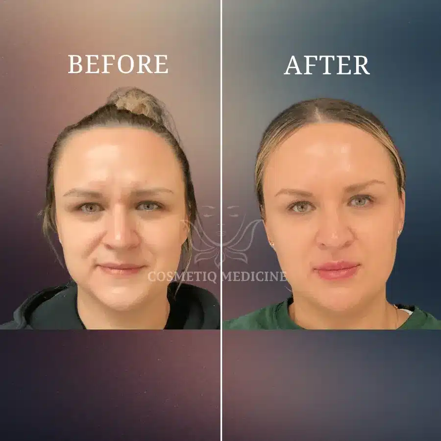 Lip filler before and after on a Portland patient showing added lip volume and a more defined upper lip