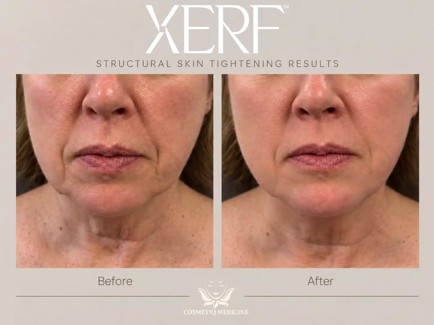XERF skin tightening before and after on a woman's lower face, jowls, and neck in front view, Cosmetiq Medicine