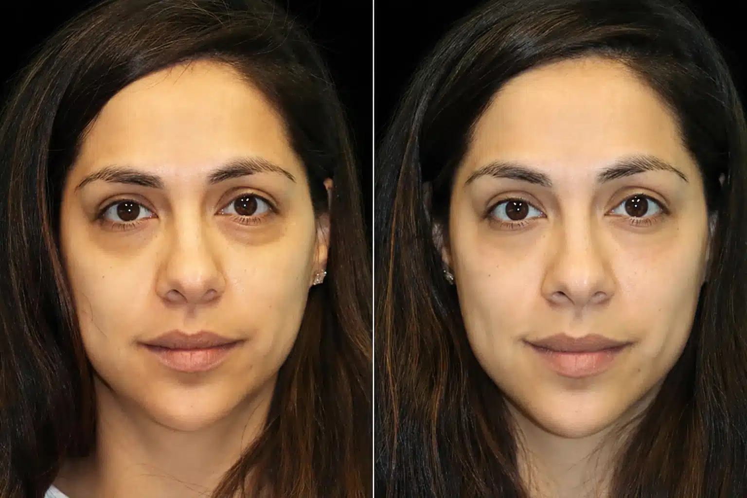 Before and after under-eye filler treatment results, Portland and Vancouver med spa
