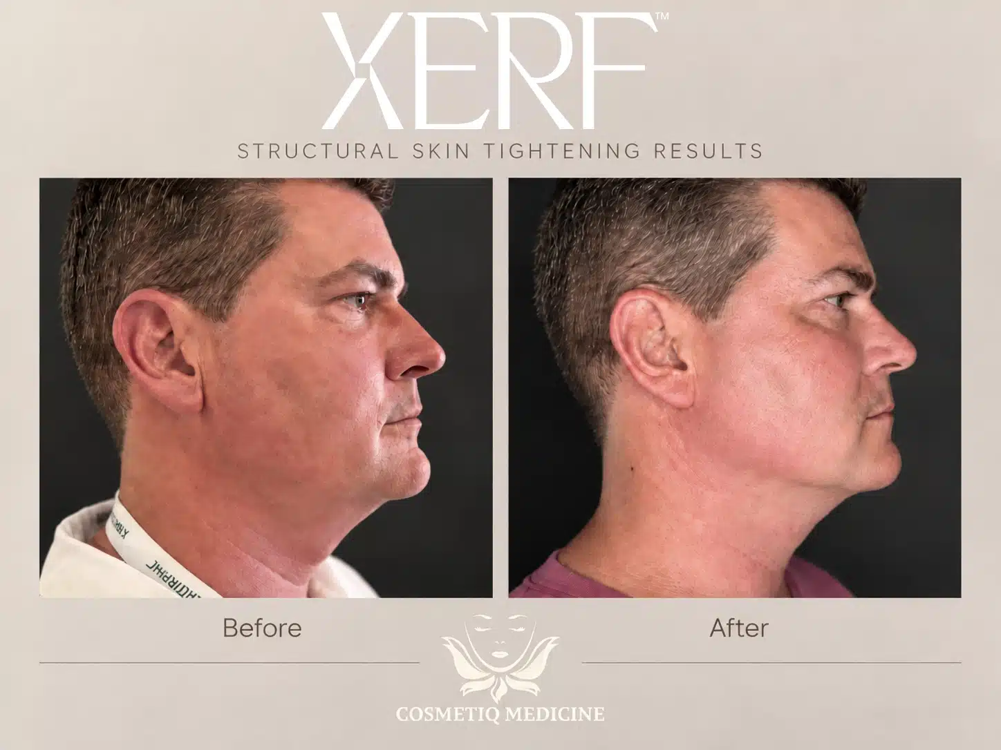 XERF skin tightening before and after on a man's jowls and jawline in side profile, Cosmetiq Medicine