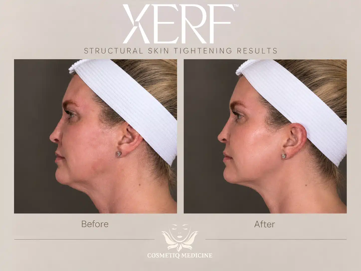 XERF skin tightening before and after showing a more defined jawline and neck on a woman in side profile, Cosmetiq Medicine