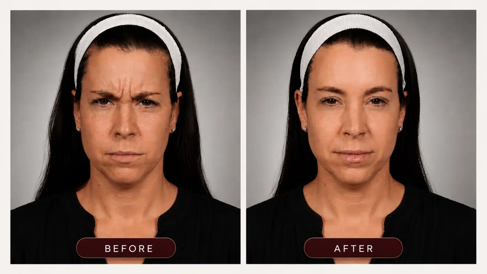 Botox and Dysport before and after results at Cosmetiq Medicine Vancouver WA