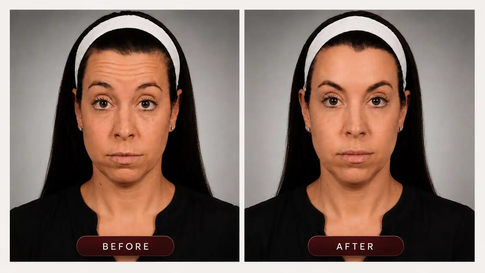 Botox and Dysport injection results Vancouver WA