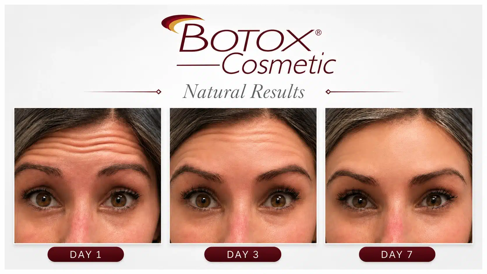 Botox before and after at Cosmetiq Medicine Vancouver WA