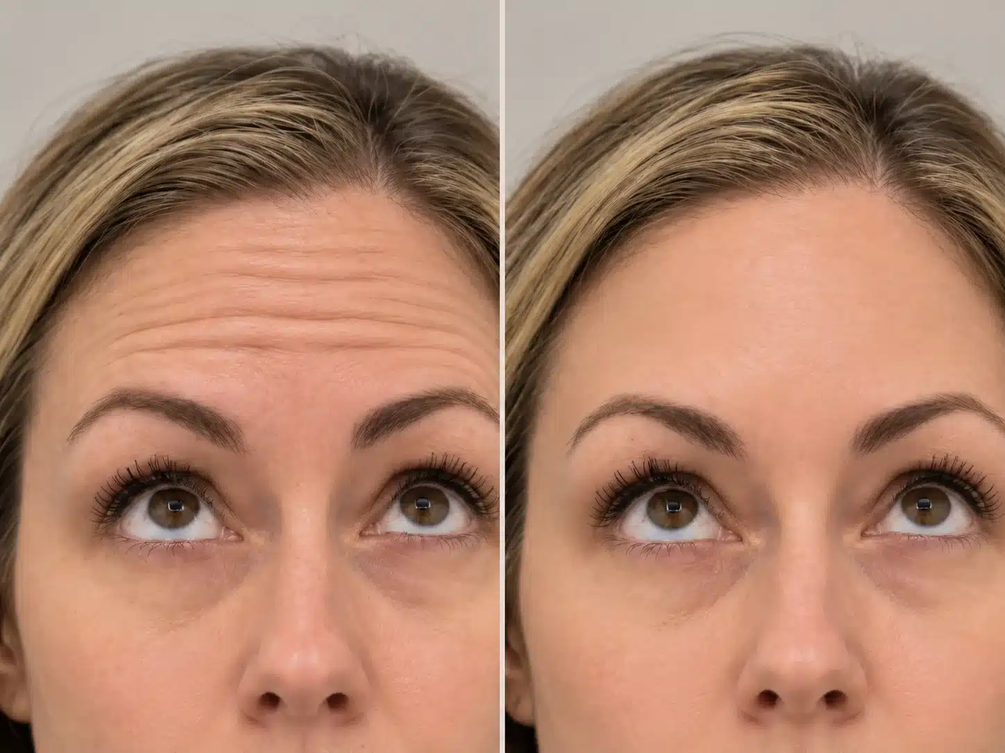 Illustration of a Botox special result, forehead lines before and smoother skin after, for the $11 a unit October Botox special at Cosmetiq Medicine in Vancouver, WA