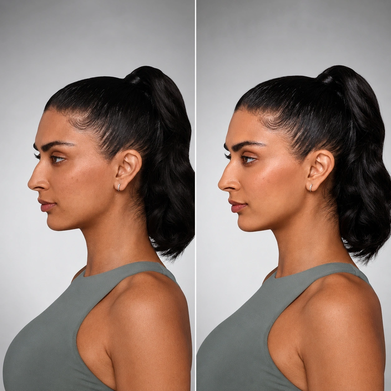 Dermal fillers before and after side profile results on a Portland patient at Cosmetiq Medicine