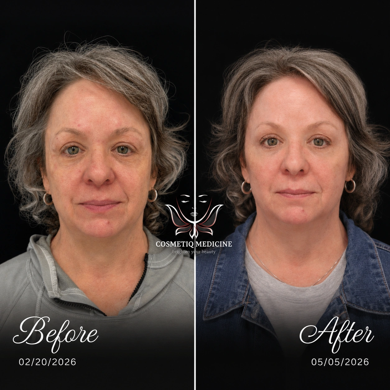 Botox, Filler & XERF Before and After Photos