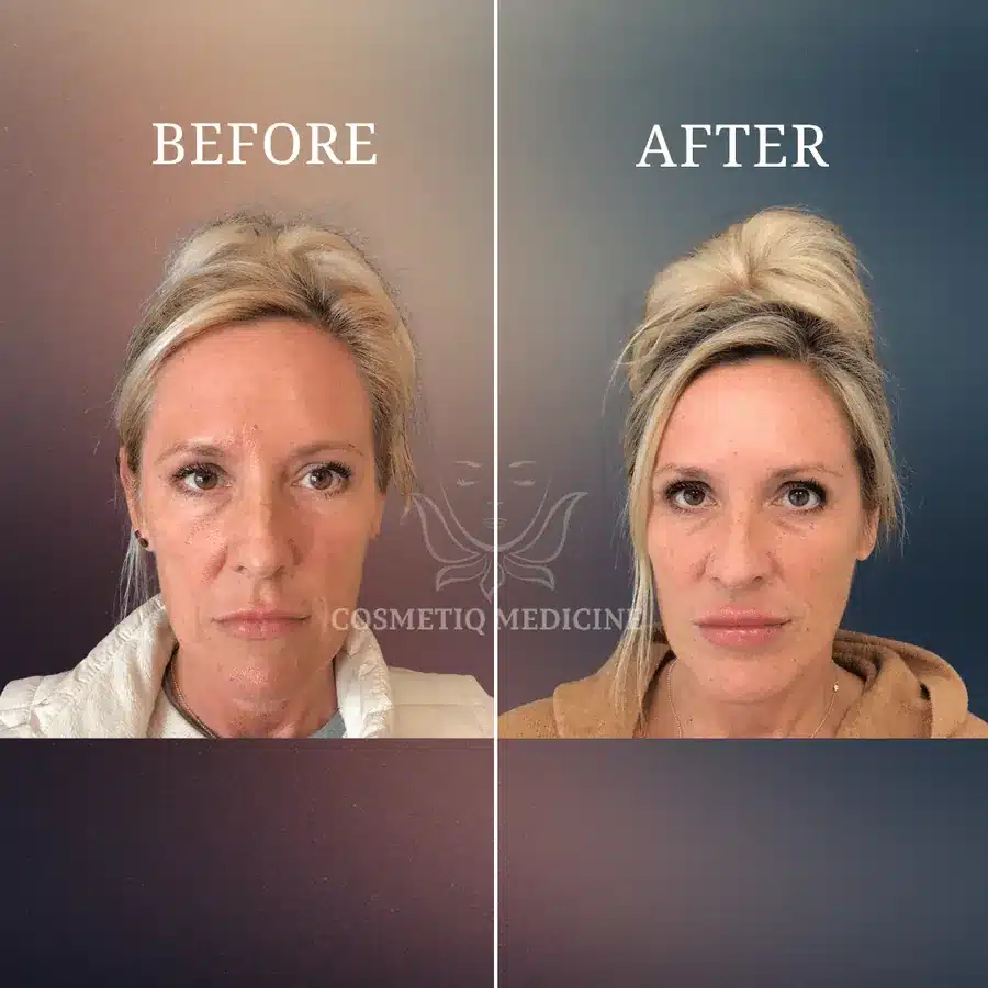 Before and after treatment result at Cosmetiq Medicine showing restored volume around the mouth