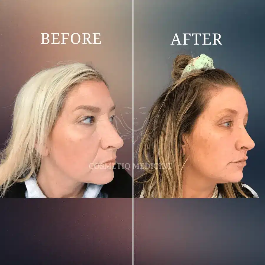 Before and after treatment result at Cosmetiq Medicine shown in profile