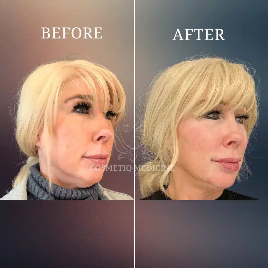 Before and after treatment result at Cosmetiq Medicine shown in three quarter view