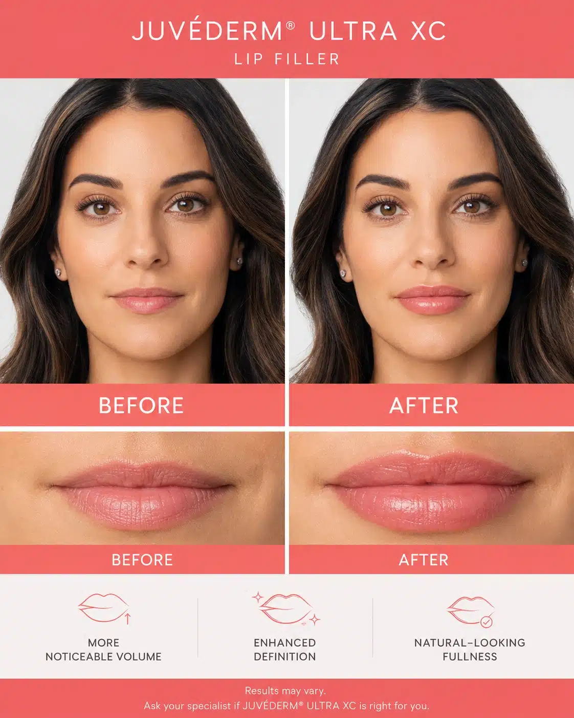 Before and after photos of a JUVÉDERM Ultra XC lip filler patient showing fuller volume, from Cosmetiq Medicine in Portland, Oregon