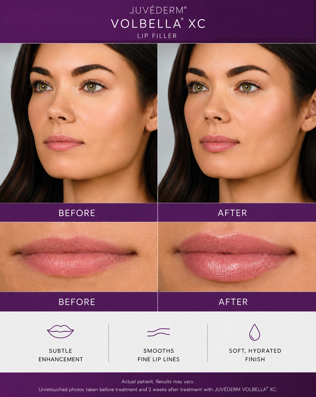 Unretouched before and after photos of a JUVÉDERM VOLBELLA XC lip filler patient showing subtle definition, from Cosmetiq Medicine in Portland, Oregon