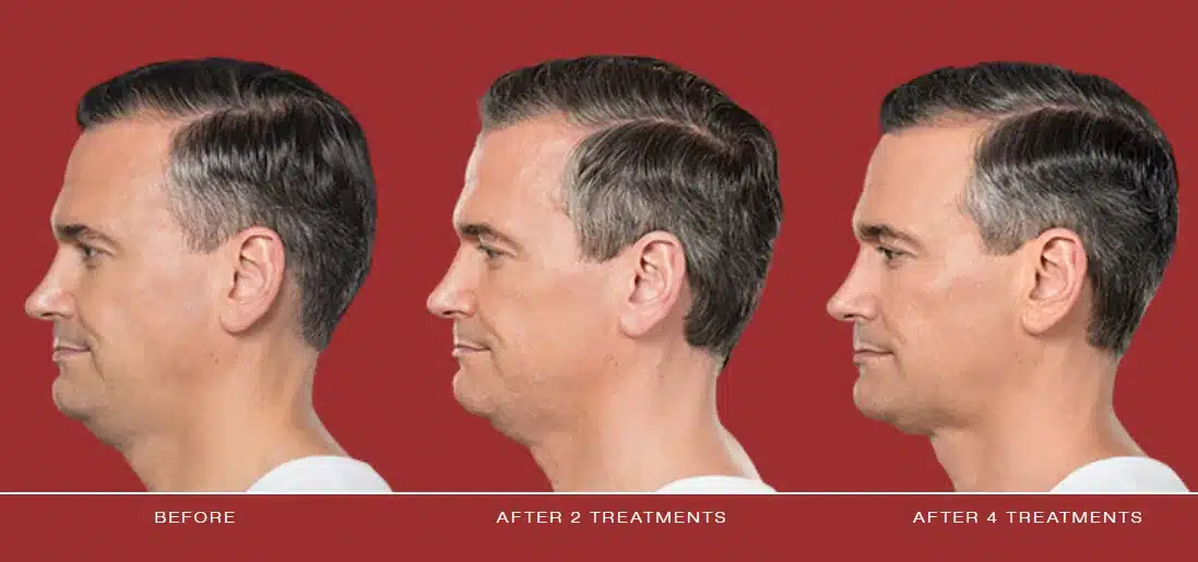 Kybella before and after: man in profile before treatment, after 2 and after 4 treatments