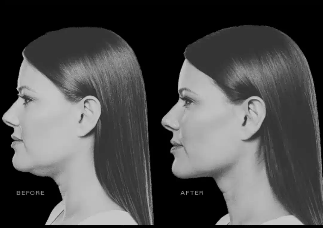 Kybella before and after: profile showing less fullness under the chin