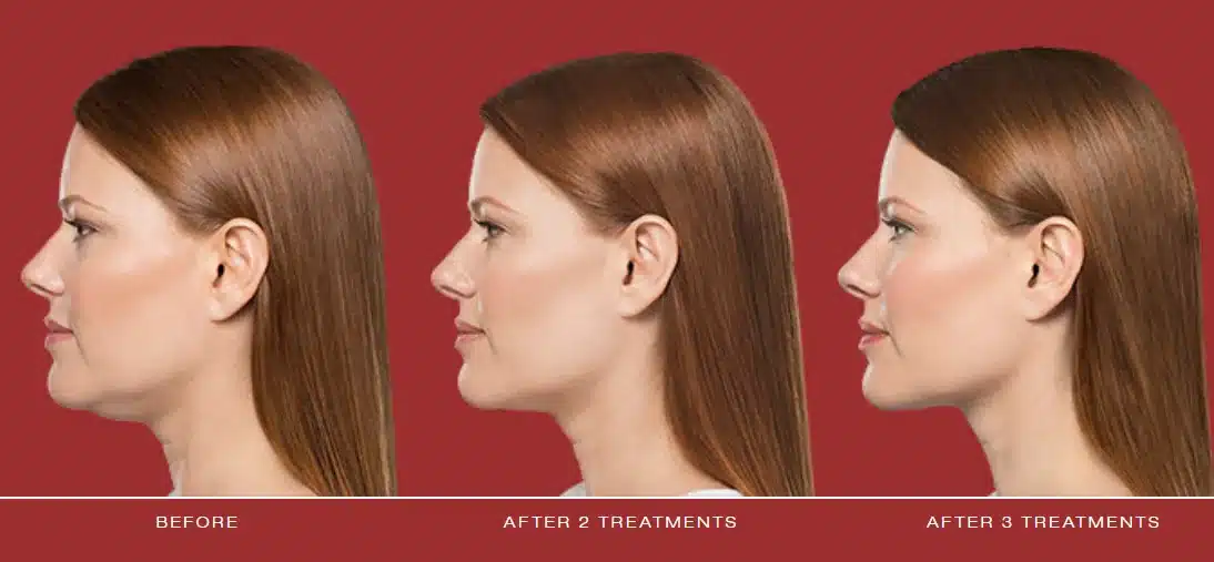 Kybella before and after: woman in profile before treatment, after 2 and after 3 treatments