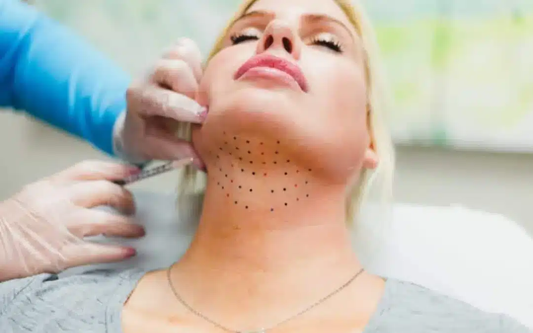 Injection grid marked under the chin before treatment