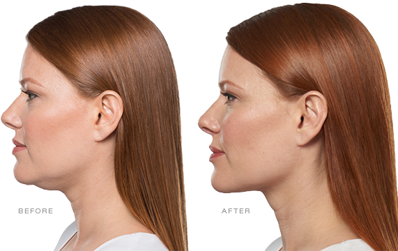 Before and After Photo showing the results of Kybella in removing a double chin from a patient.