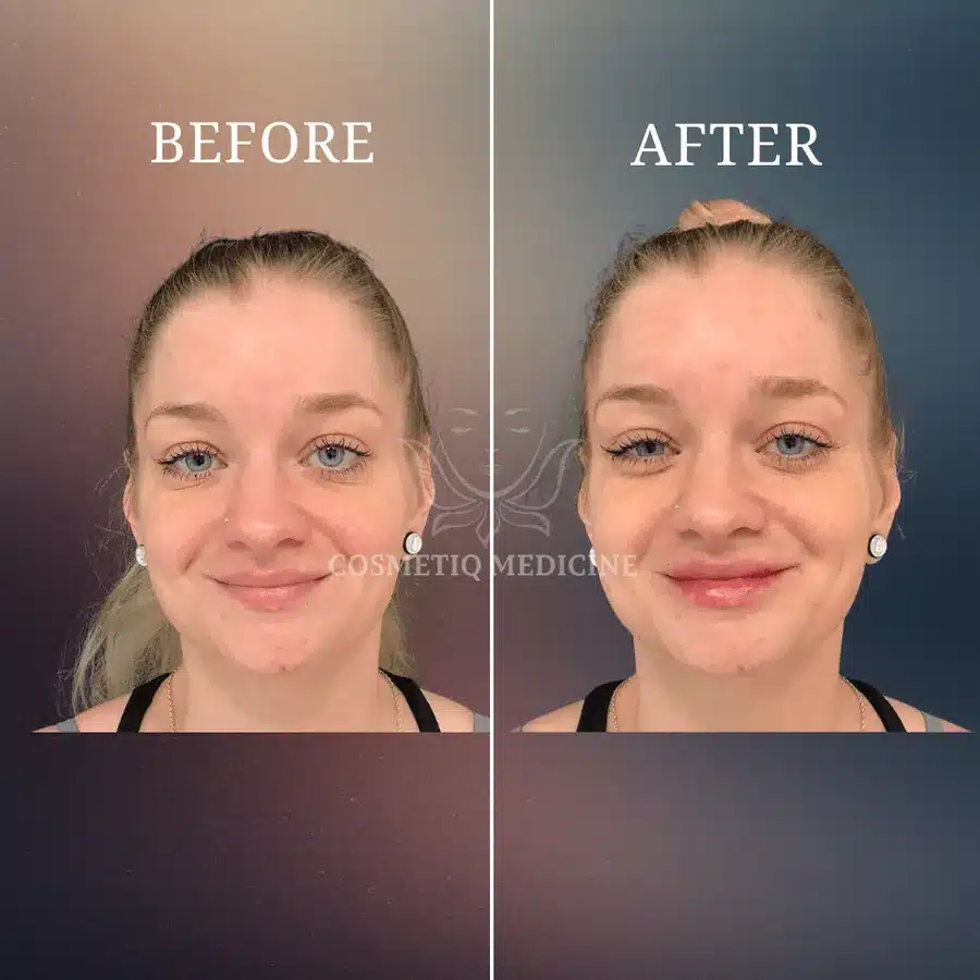 Lip filler before and after showing a subtle change in lip volume
