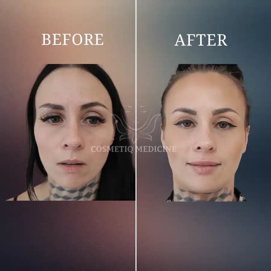 Lip filler before and after showing improved lip definition and volume