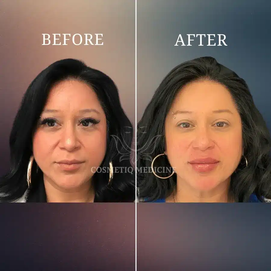 Lip filler before and after showing fuller lips with the surrounding face in frame