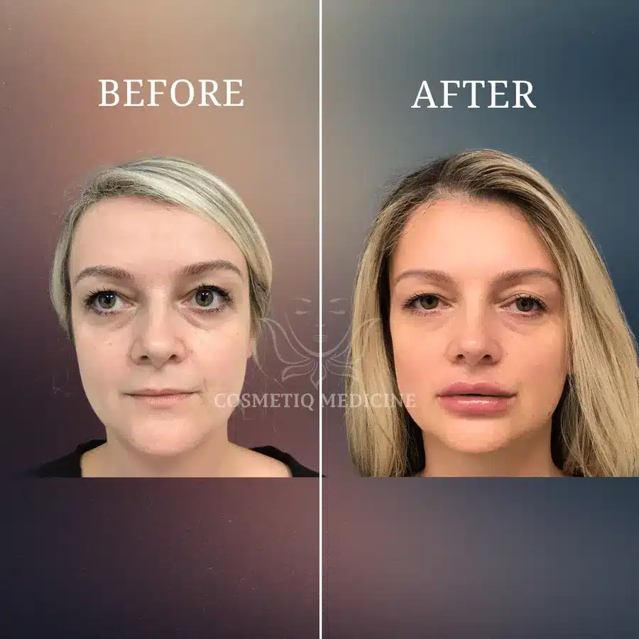 Lip filler before and after showing fuller lips within a full face view